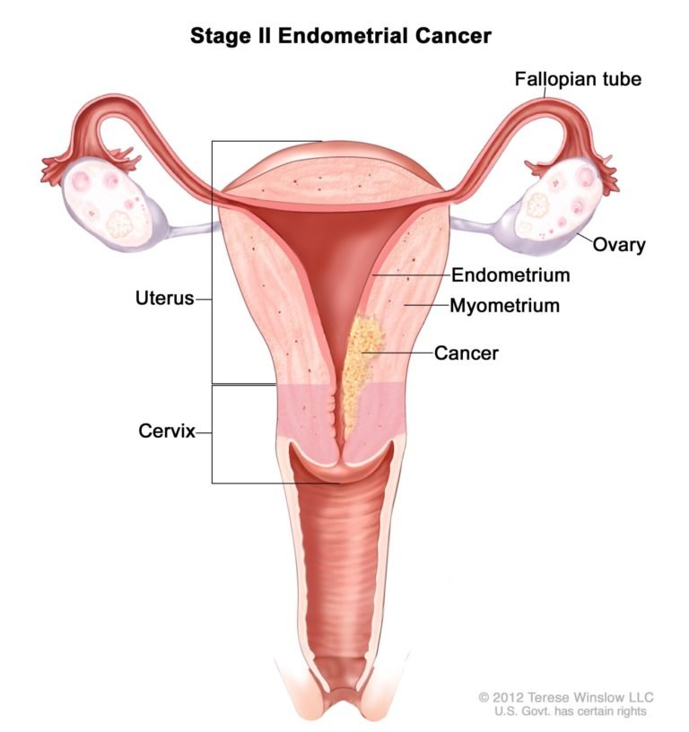 Read more about the article Hair Relaxer Endometrial Cancer Lawsuits